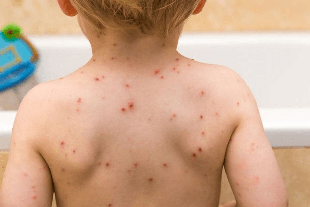 meningitis in children