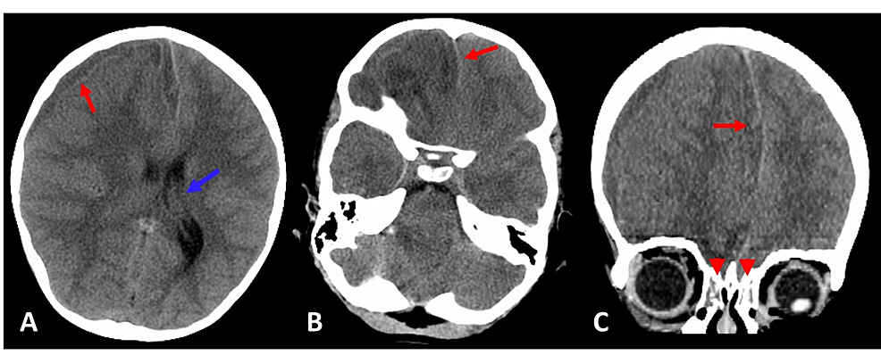 brain abscess in children