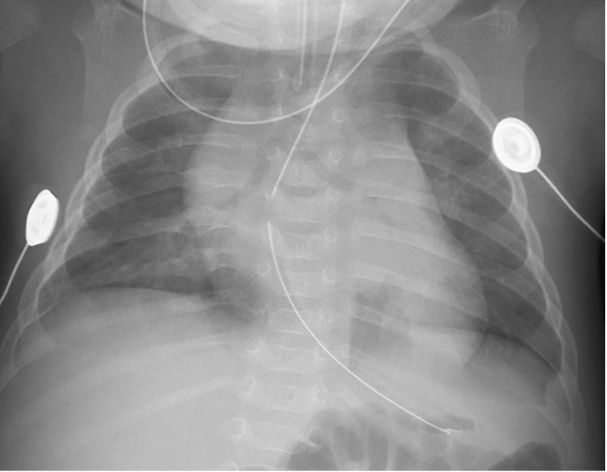 posterior-rib-fracture Figure 1. Posterior Rib Fracture