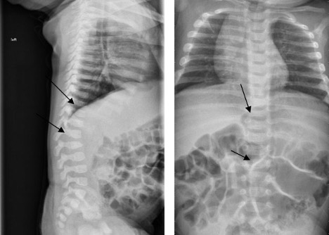 spinous-process-fracture Figure 2. Spinous Process Fracture