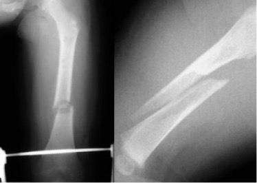 spiral-fracture Figure 3. Spiral Fracture