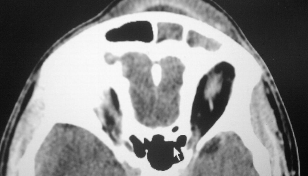 Pott's Puffy Tumor Pediatric Medical Experts