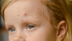 Monkeypox and the Impact of Pediatric Infections