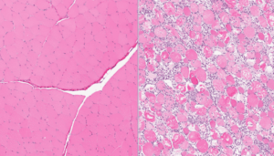 Rhabdomyolysis in Children