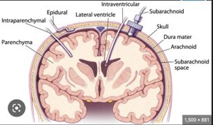 increased intracranial pressure ICP