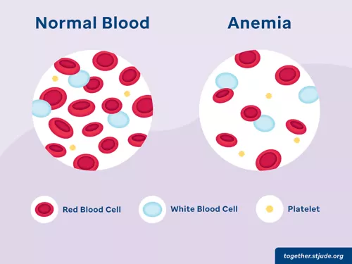 Iron Deficiency Anemia