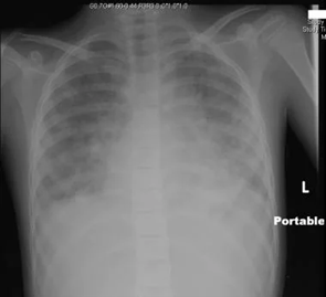 Pediatric Acute Respiratory Distress Syndrome (PARDS)